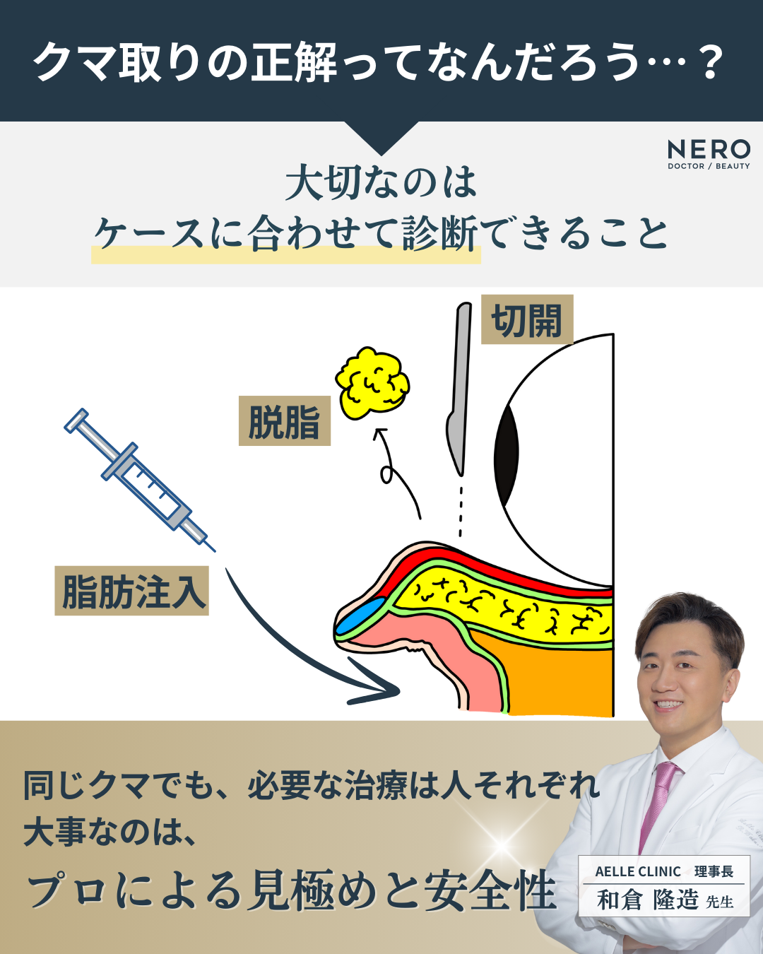 目の下の脂肪取りで失敗しないために。切らずに自然に整える、アエルクリニックの理想のクマ取り