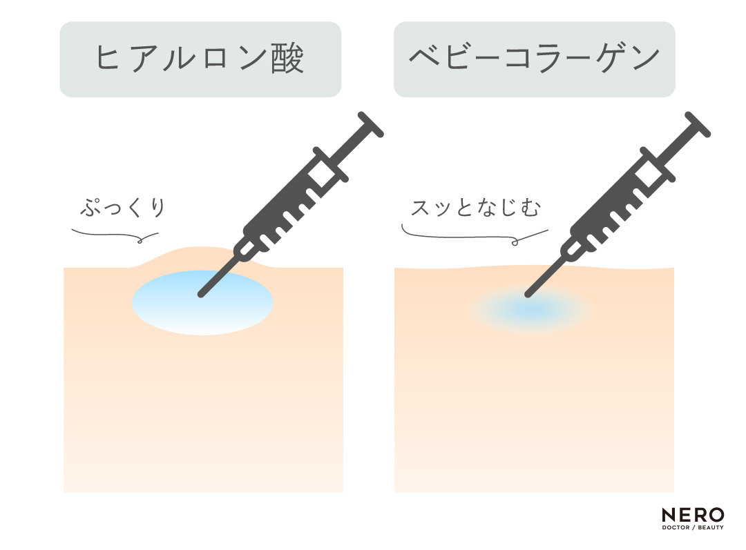 ヒアルロン酸とベビーコラーゲンの違い　ベビーコラーゲン再評価。注入剤としてのベビーコラーゲン―ECM*（細胞外マトリックス）研究の進展と臨床応用｜NERO DOCTOR / BEAUTY（美容医療）