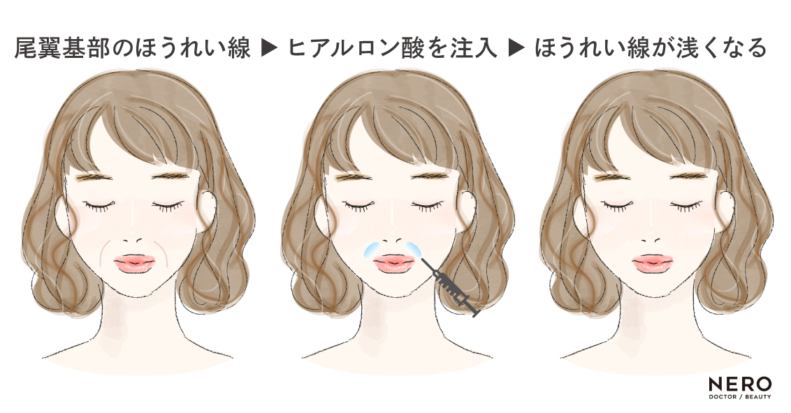 “線”ではなく“構造”―鼻翼基部ヒアルロン酸・貴族手術・ジュブゼンでのアプローチとは