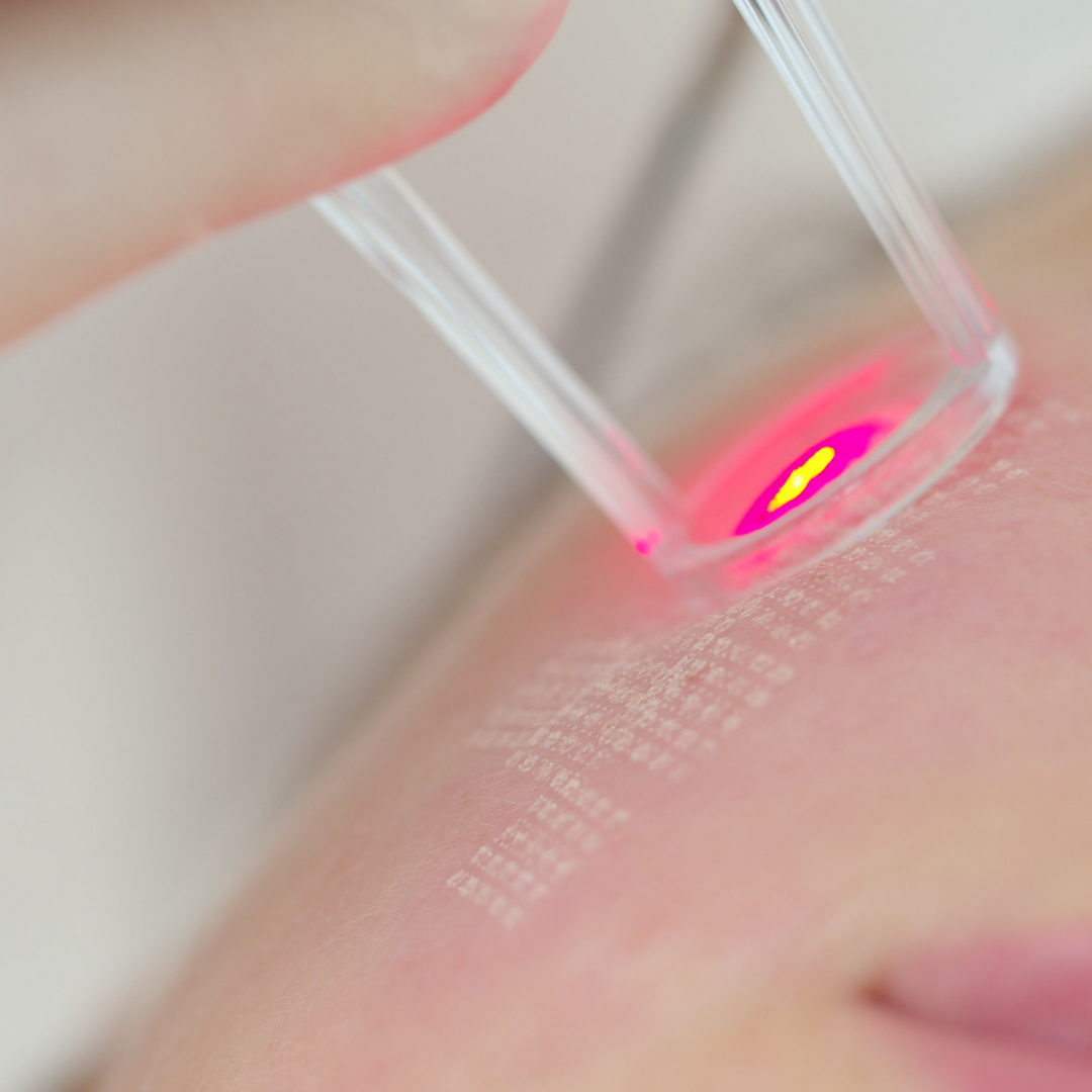 レーザー　シミ取りに行く前の教科書—PIH（炎症後色素沈着）を防ぐために知るべきこと｜NERO DOCTOR / BEAUTY（美容医療）