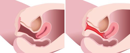 腟デバイス大全―RF・HIFU・CO2・Er:YAGを科学的に比較する｜NERO DOCTOR / BEAUTY（美容医療）