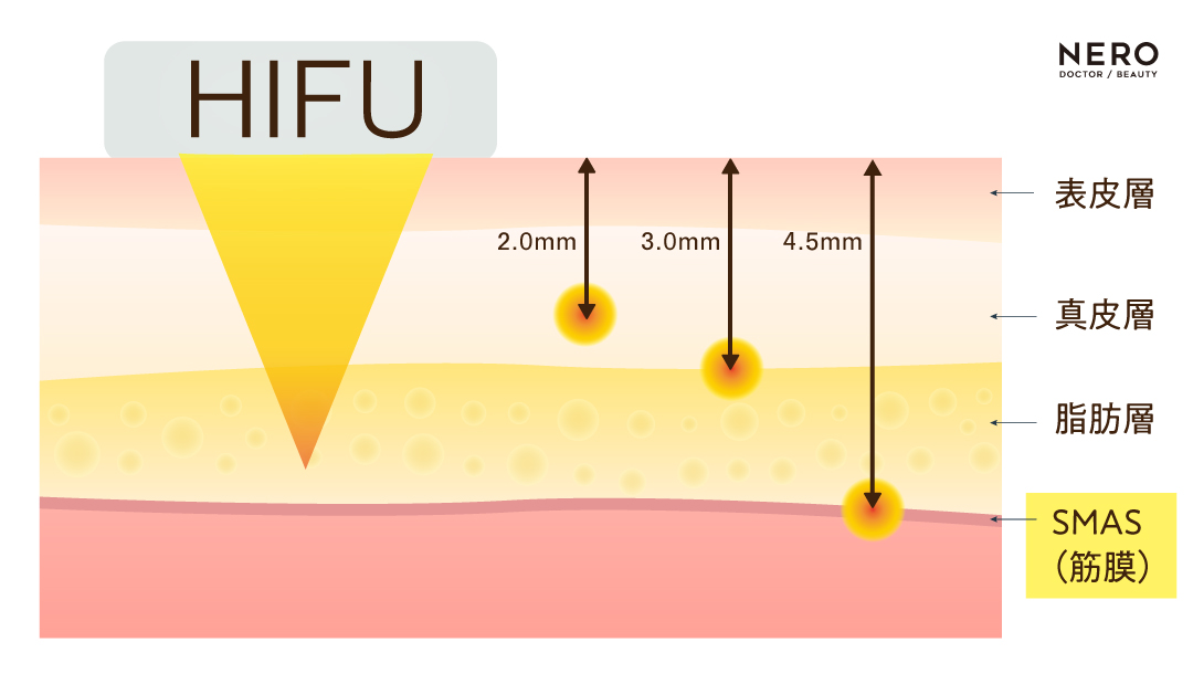 腟HIFU　腟デバイス大全―RF・HIFU・CO2・Er:YAGを科学的に比較する｜NERO DOCTOR / BEAUTY（美容医療）