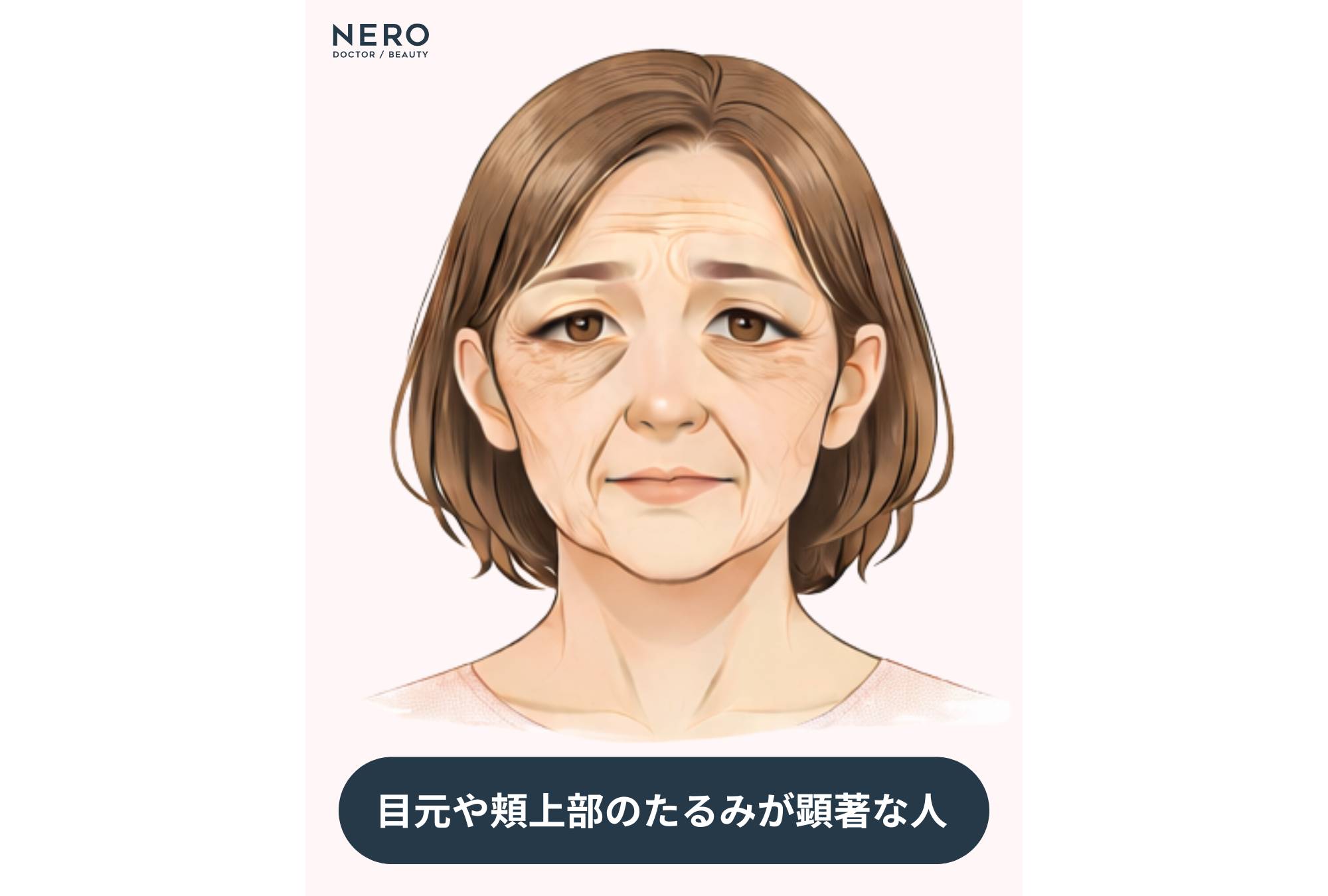 こめかみリフトで目指せる変化とは？他のリフト施術との違いも｜NERO DOCTOR / BEAUTY（美容医療）