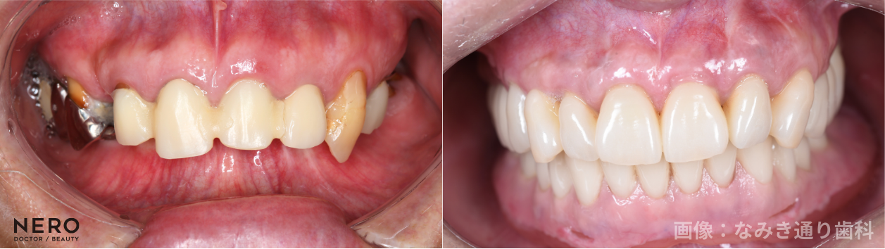 【審美歯科】名古屋のなみき通り歯科が提案する美と健康の新基準！ガミースマイル治療からセラミック、矯正まで