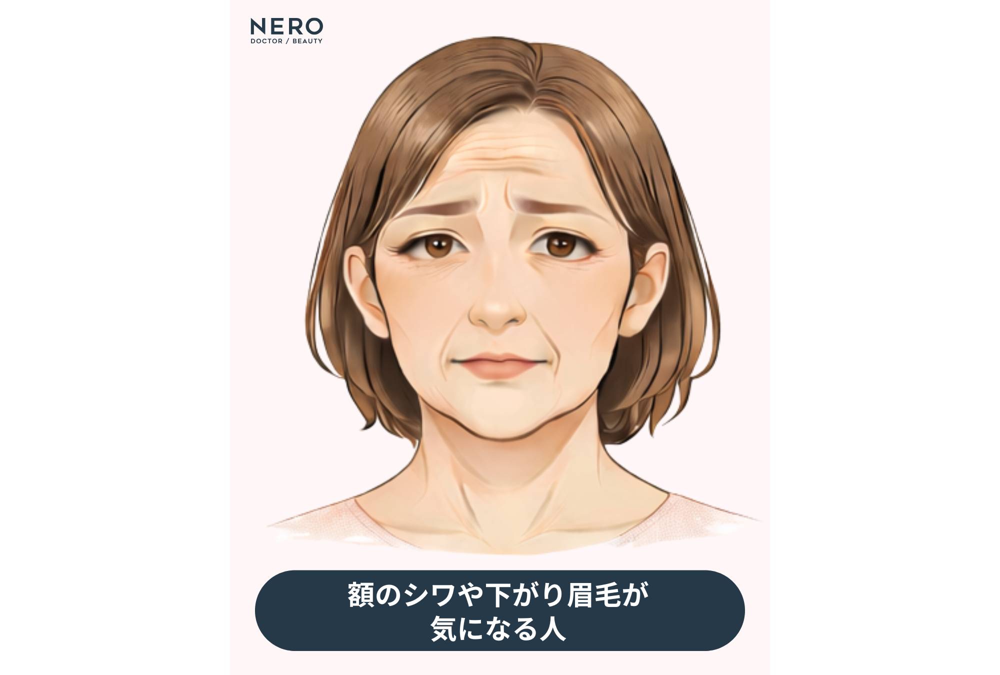 こめかみリフトで目指せる変化とは？他のリフト施術との違いも｜NERO DOCTOR / BEAUTY（美容医療）