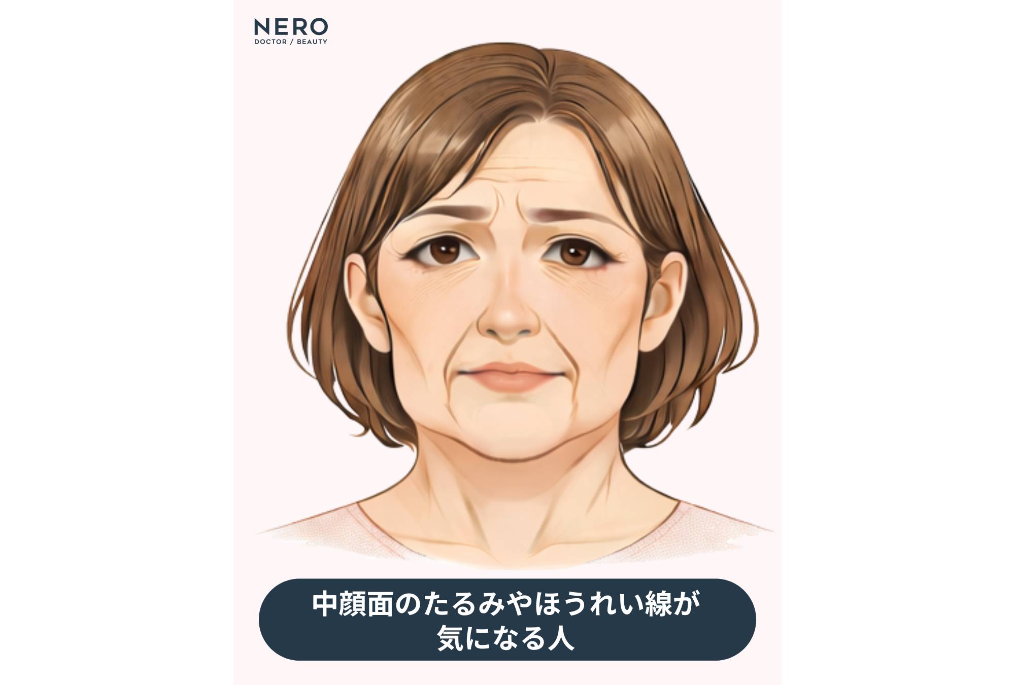 こめかみリフトで目指せる変化とは？他のリフト施術との違いも｜NERO DOCTOR / BEAUTY（美容医療）