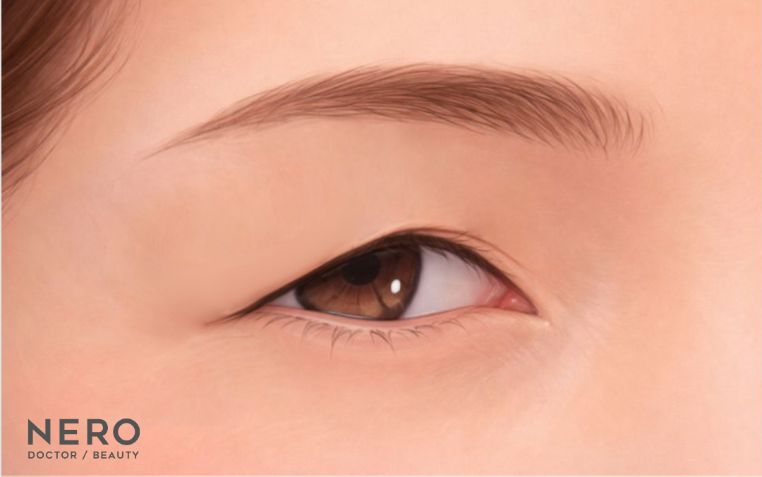 まぶたのたるみ取りは埋没だけじゃ限界?埋没と切開どっちがいいか悩む方に…ナチュラルな二重切開という新しい選択肢【オーキッド美容クリニック東京御徒町】