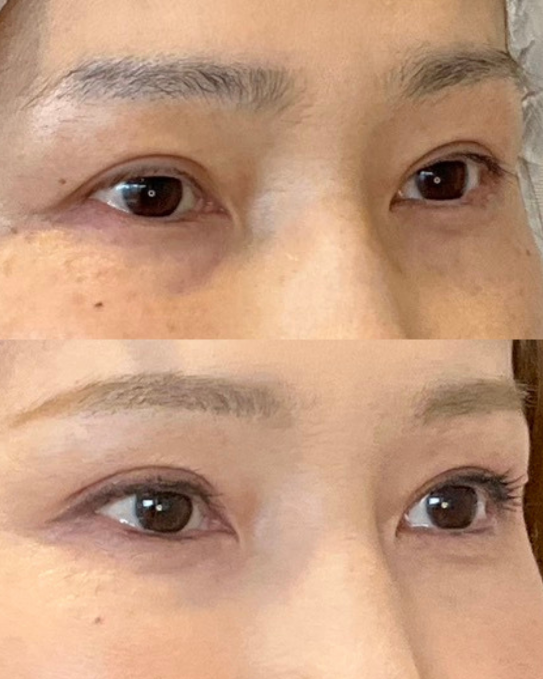 まぶたのたるみ取りは埋没だけじゃ限界?埋没と切開どっちがいいか悩む方に…ナチュラルな二重切開という新しい選択肢【オーキッド美容クリニック東京御徒町】