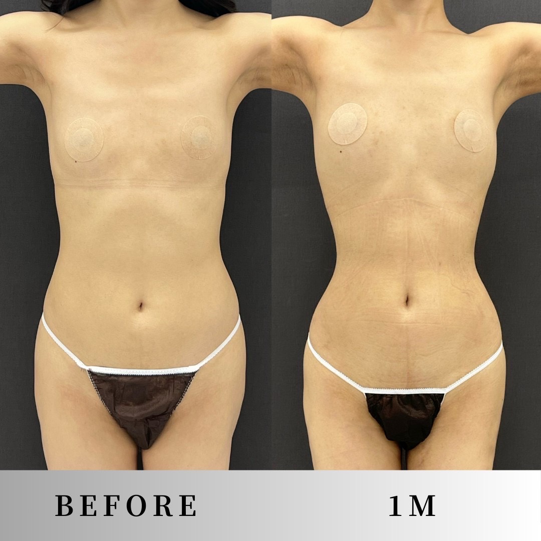 肋骨リモデリングで細いウエストを叶える|くびれ形成の新常識!骨から整えるボディデザイン|NERO DOCTOR / BEAUTY(美容医療)