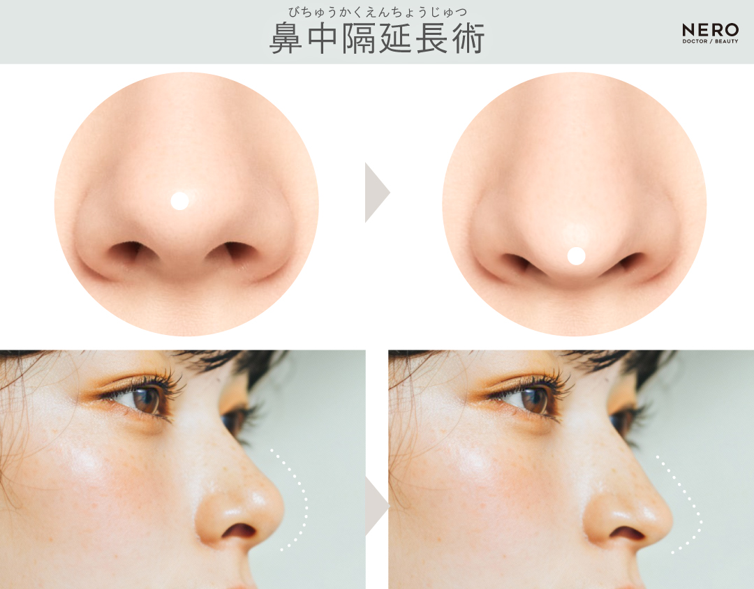 鼻中隔延長術　鼻筋や鼻先を整えるだけじゃ足りない―鼻の穴の“見え方”をデザインする3つのアプローチとは｜NERO DOCTOR/BEAUTY（美容医療）