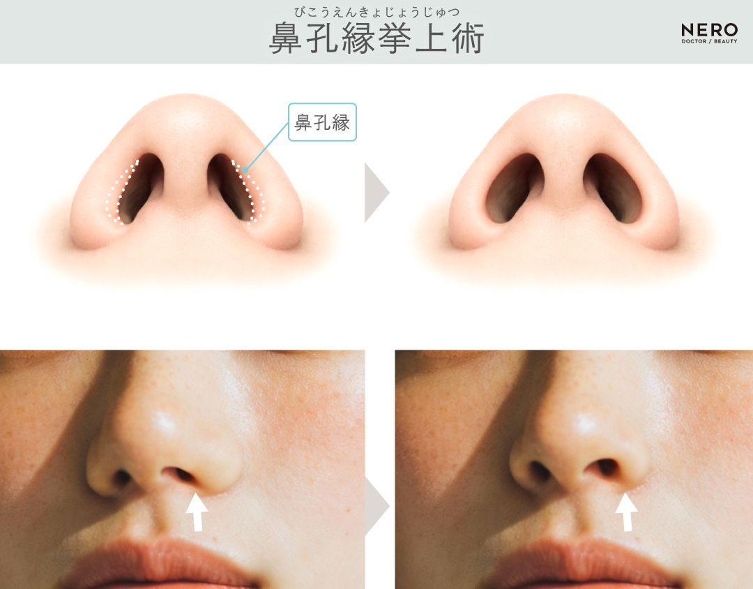 鼻孔縁挙上術　鼻筋や鼻先を整えるだけじゃ足りない―鼻の穴の“見え方”をデザインする3つのアプローチとは｜NERO DOCTOR/BEAUTY（美容医療）