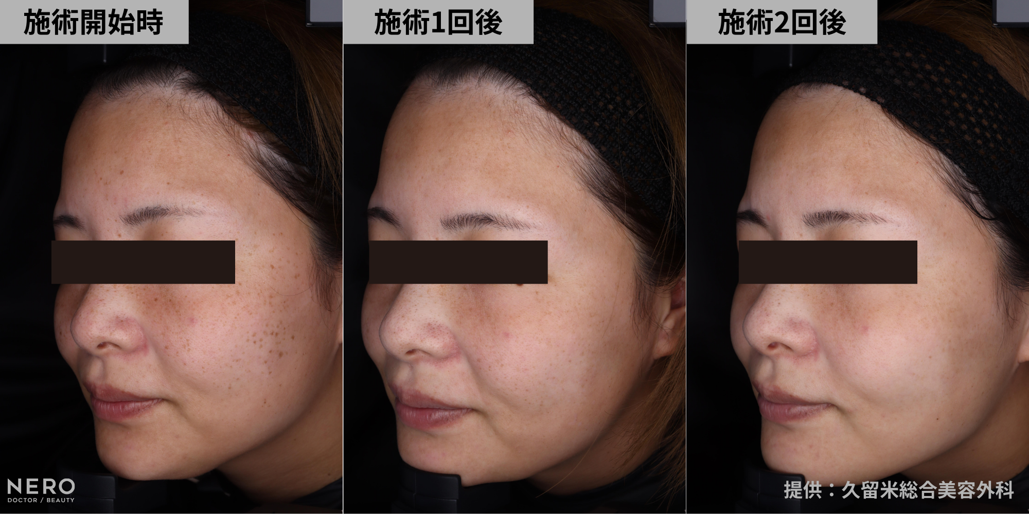 シミ取りでシミが濃くなる？医師が解説！｜NERO DOCTOR / BEAUTY（美容医療）