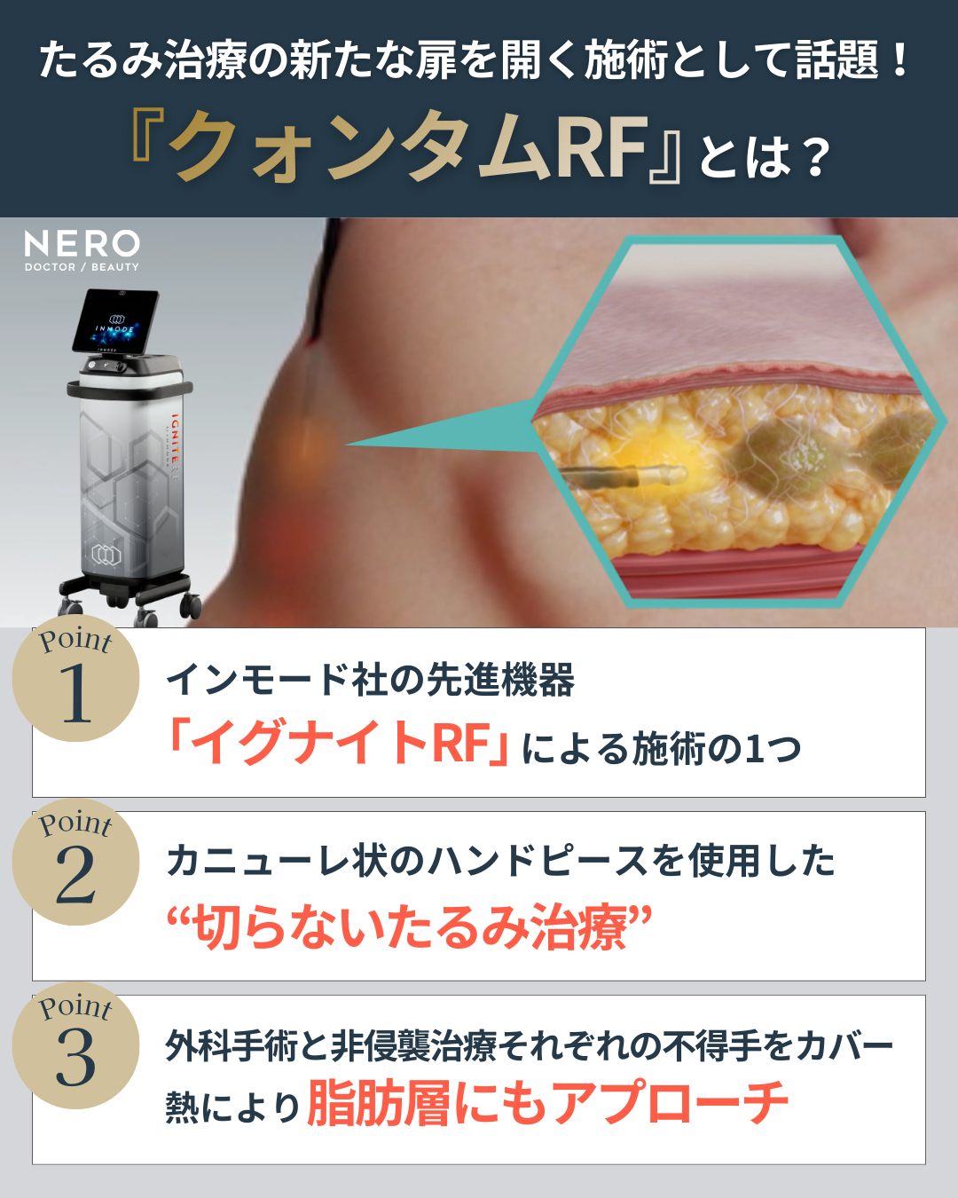 イグナイトRFによるクォンタムRF施術とは？