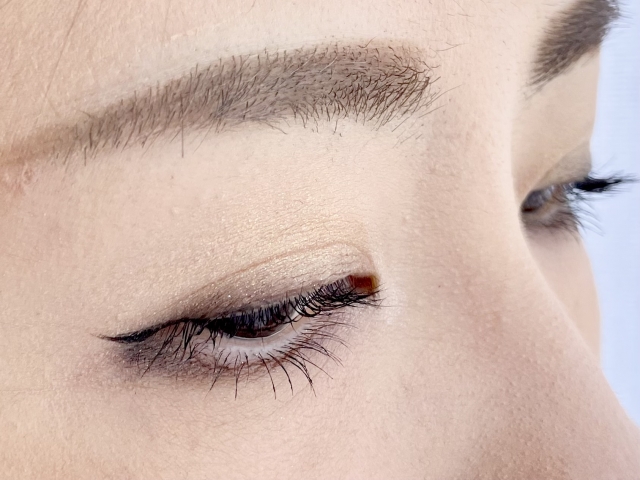 ハム目は失敗？ダウンタイム中の腫れとの見分け方と相談のタイミング