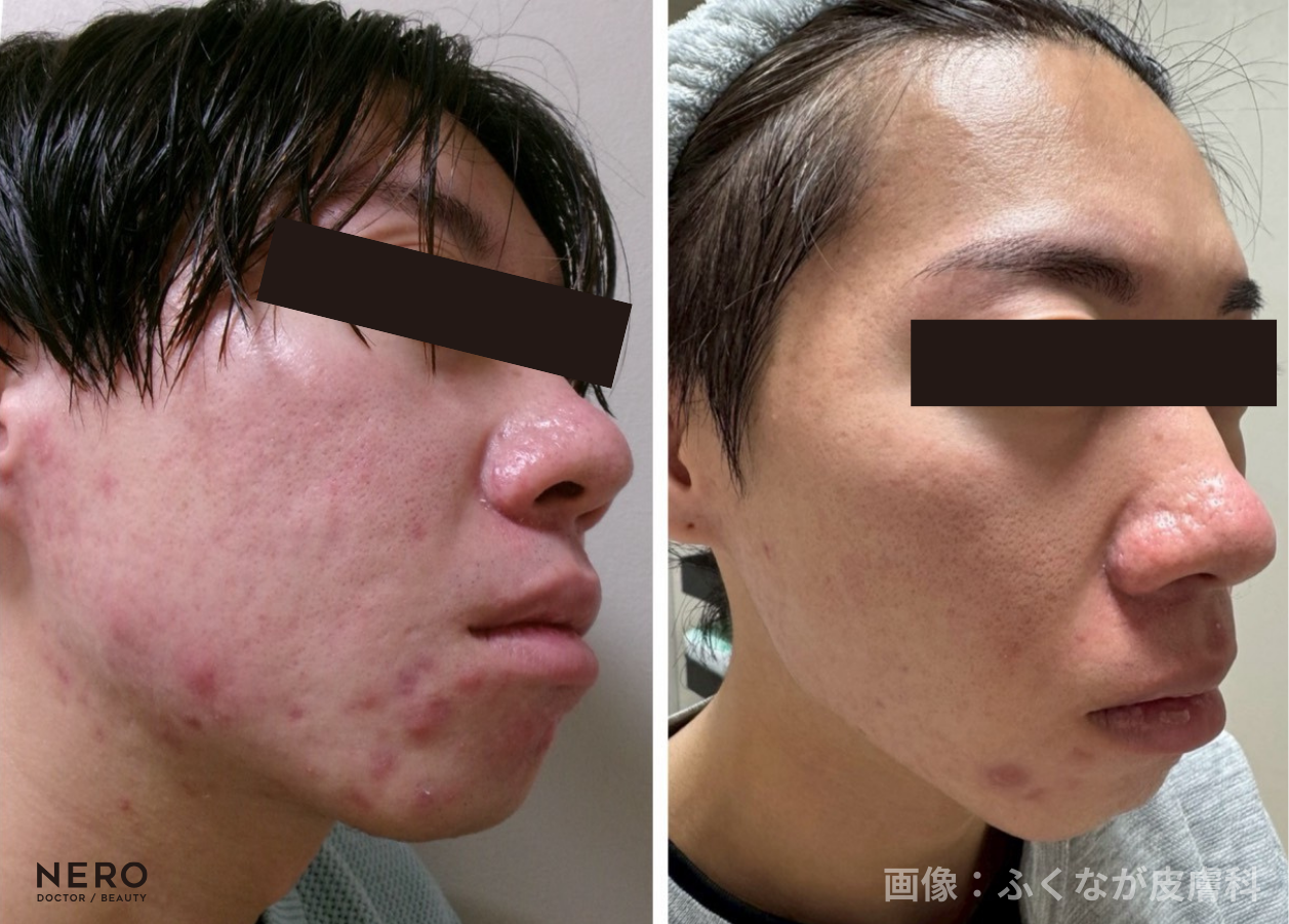 ニキビの治し方は自宅での再現性がカギ！最短3ヶ月での実感を目指す滋賀・ふくなが皮膚科の治療方針とは