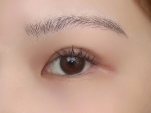 ハム目とは？二重整形で起こる見た目の特徴と原因をやさしく解説