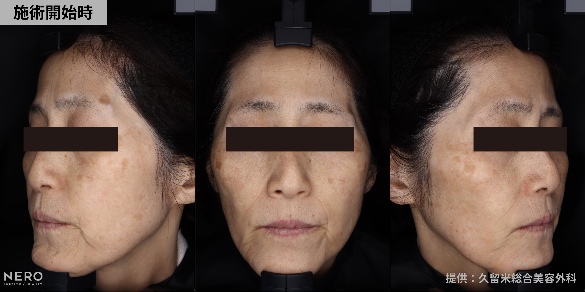 シミ取りでシミが濃くなる？医師が解説！｜NERO DOCTOR / BEAUTY（美容医療）