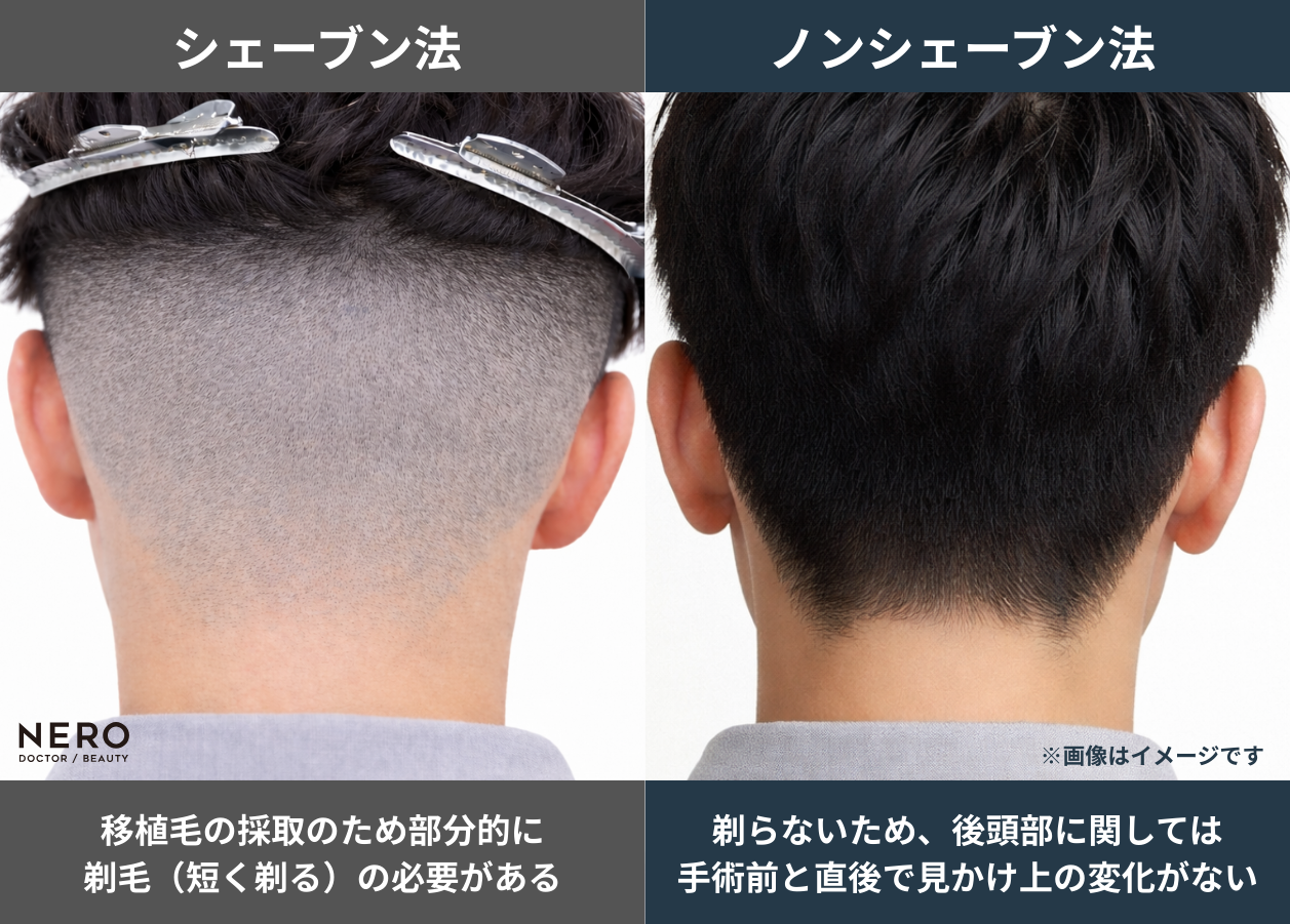 生え際後退の原因は薄毛だけじゃない？薄毛治療専門クリニック【ヘアオブ東京】に聞く“自然で美しいデザイン植毛”とは