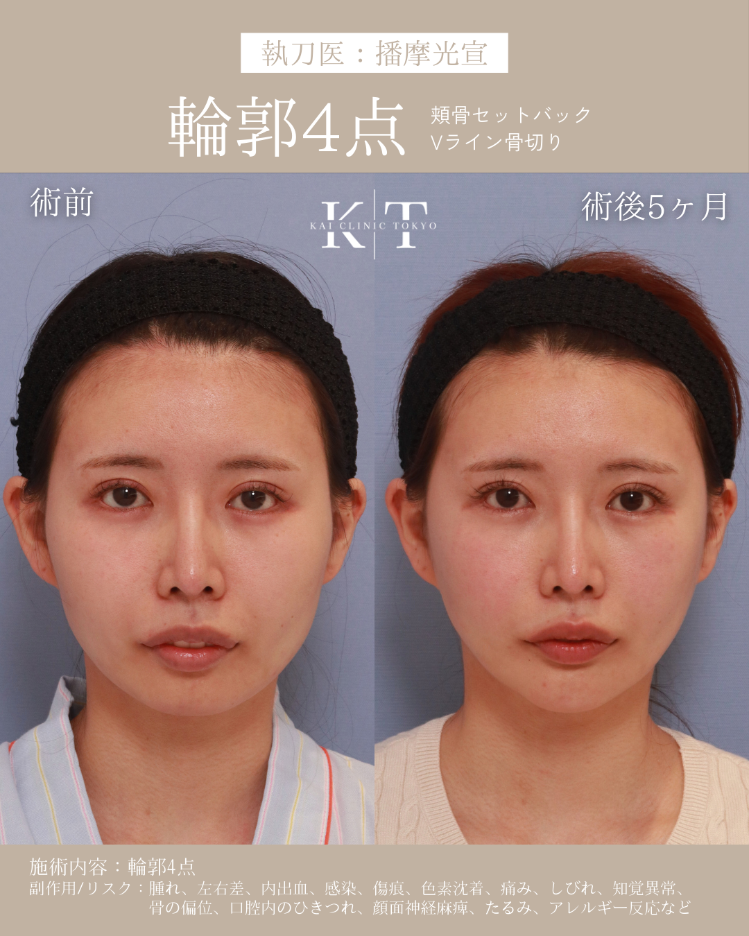 本気で顔を小さくしたい!骨格のプロが解説|NERO DOCTOR / BEAUTY(美容医療)