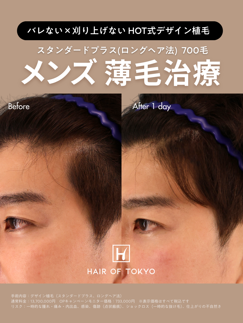 生え際後退の原因は薄毛だけじゃない？薄毛治療専門クリニック【ヘアオブ東京】に聞く“自然で美しいデザイン植毛”とは