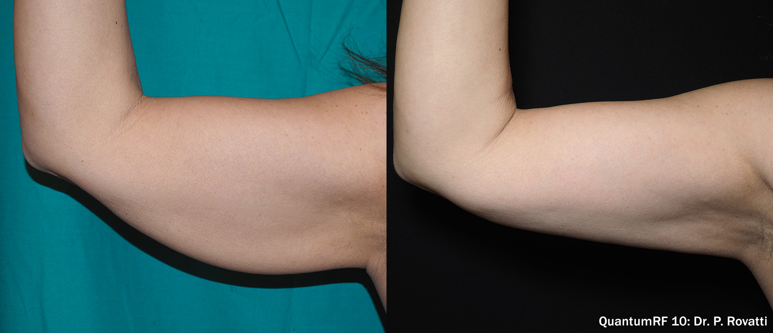 イグナイトRFによるクォンタムRF施術とは？