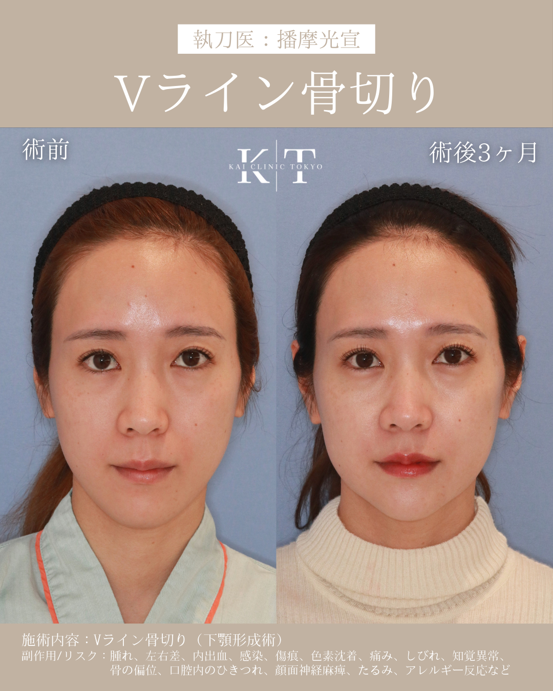 本気で顔を小さくしたい!骨格のプロが解説|NERO DOCTOR / BEAUTY(美容医療)