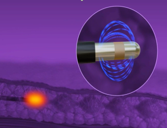 イグナイトRFによるクォンタムRF施術とは？