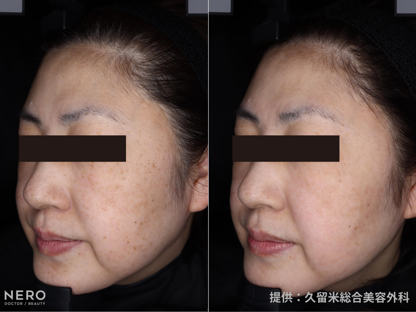 シミ取りでシミが濃くなる？医師が解説！｜NERO DOCTOR / BEAUTY（美容医療）