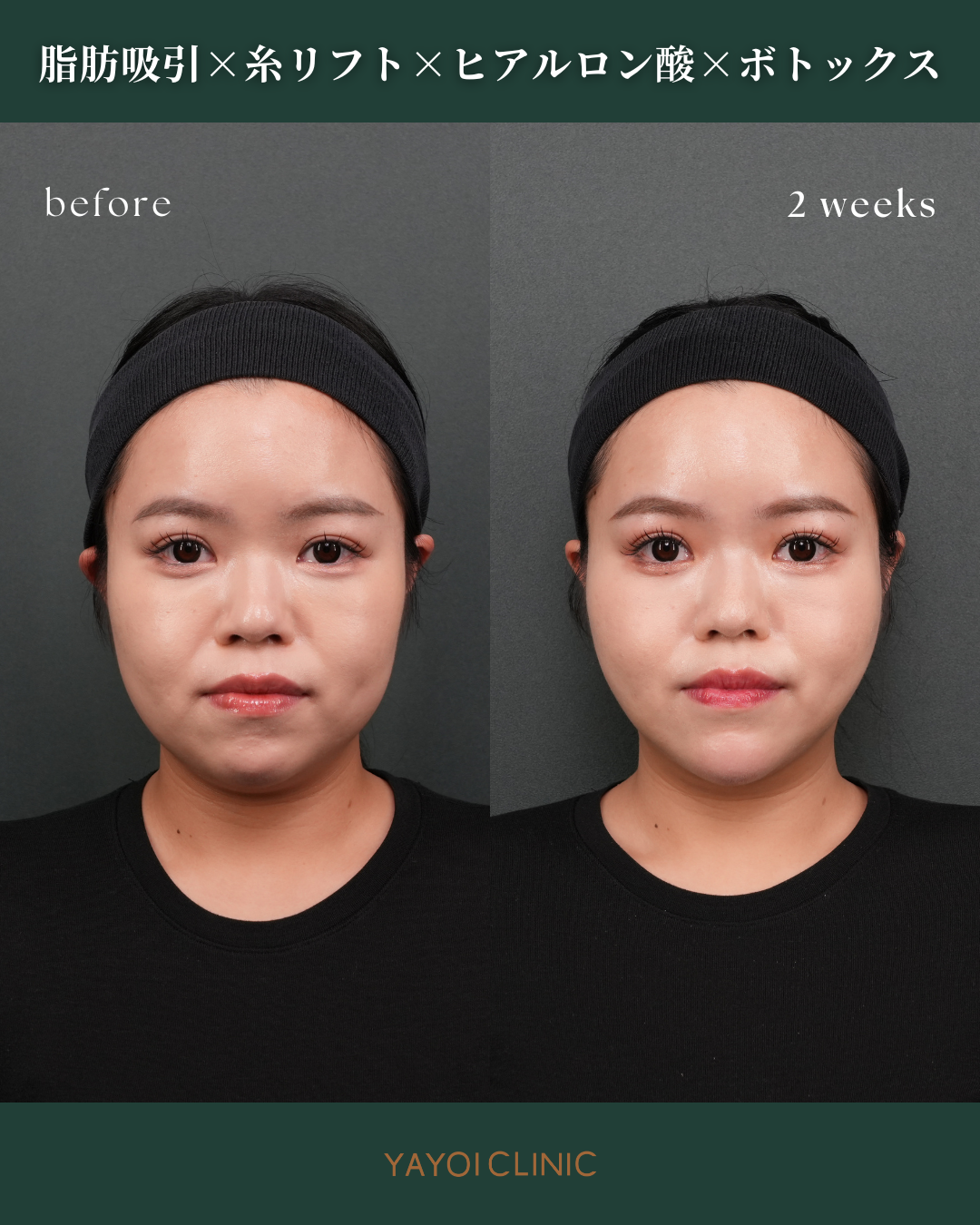 広島YAYOI CLINICの美容外科『毎週外科day』に注目！おすすめされる理由と施術内容