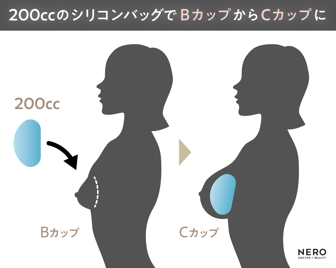 豊胸シリコンの歴史と最新トレンド！素材・デザイン・寿命のすべてを徹底解説｜NERO DOCTOR / BEAUTY（美容医療）
