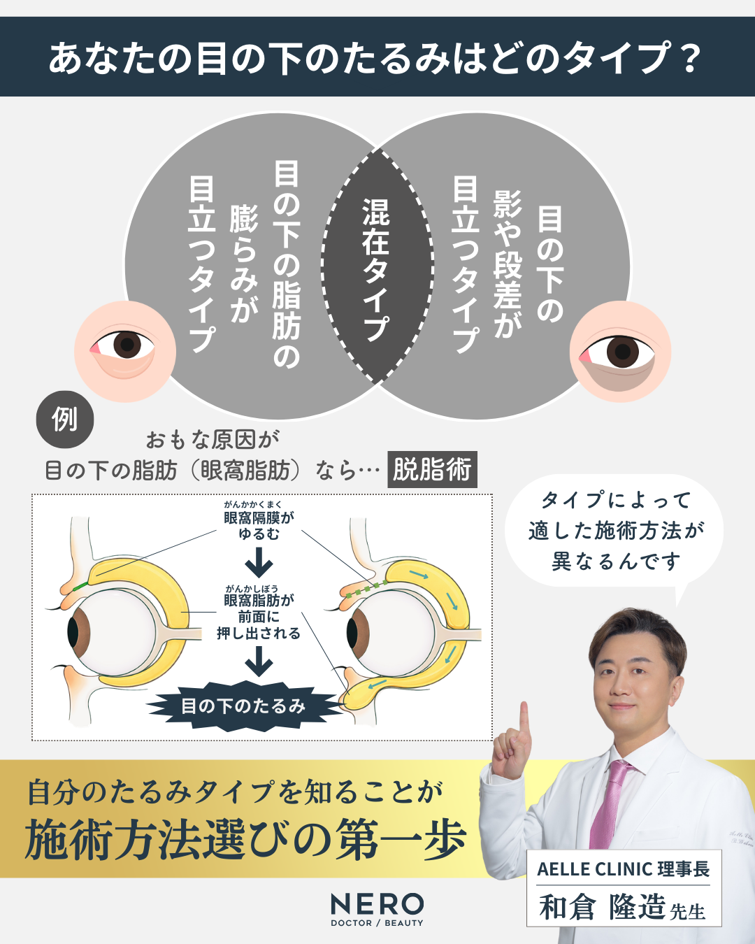 目の下の脂肪取り、どの方法が正解？たるみ別の対処法をアエルクリニック和倉理事長に聞いた！