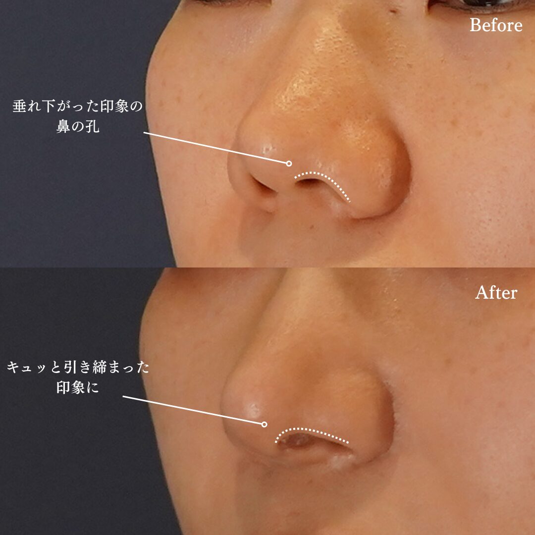 鼻の穴がコンプレックス？形成外科の知識×美容外科のセンスで導く失敗しない鼻整形【LIVIN CLINIC監修】