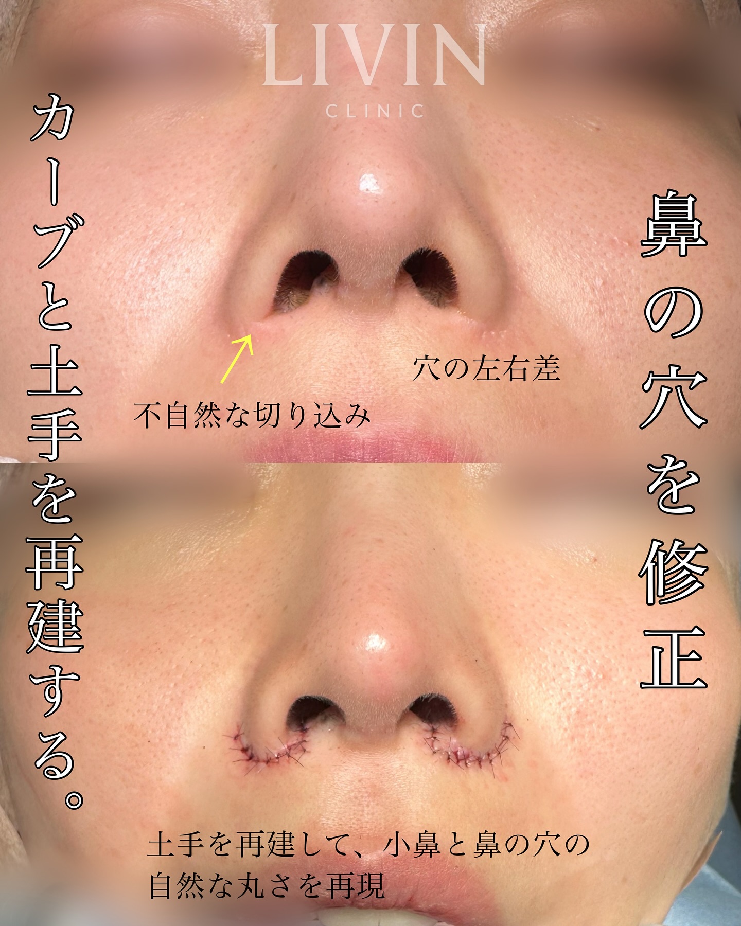鼻の穴がコンプレックス？形成外科の知識×美容外科のセンスで導く失敗しない鼻整形【LIVIN CLINIC監修】