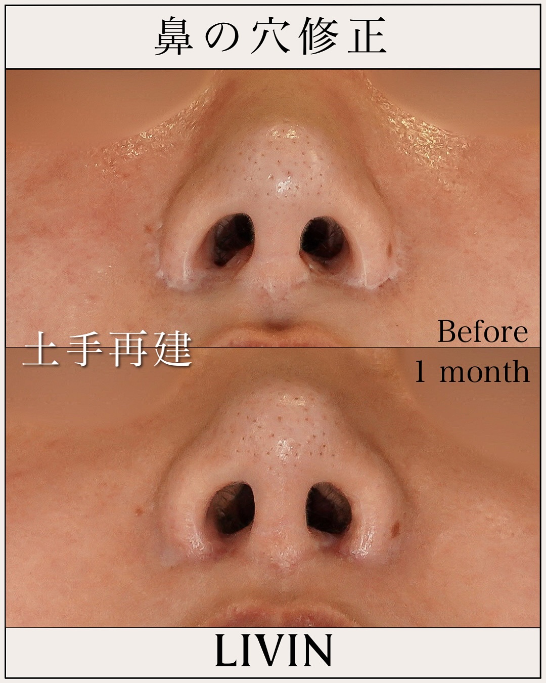 鼻の穴がコンプレックス？形成外科の知識×美容外科のセンスで導く失敗しない鼻整形【LIVIN CLINIC監修】