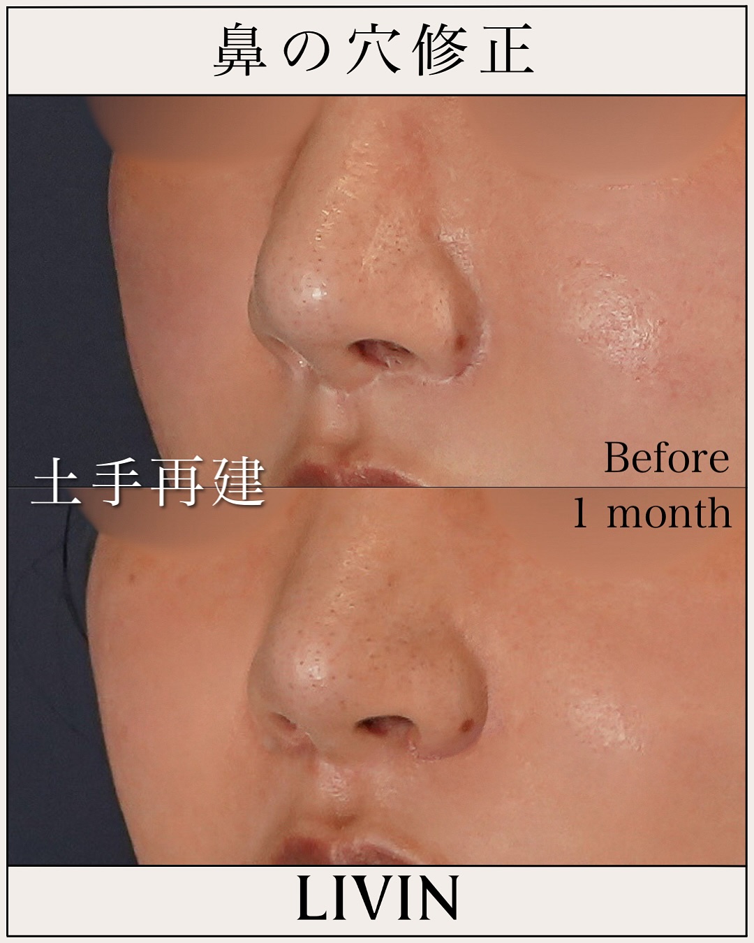 鼻の穴がコンプレックス？形成外科の知識×美容外科のセンスで導く失敗しない鼻整形【LIVIN CLINIC監修】