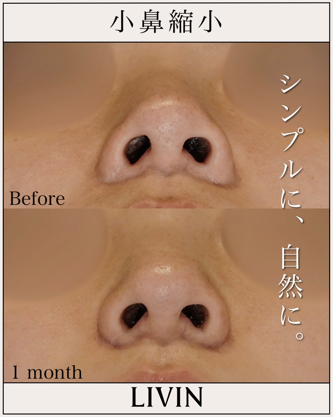 鼻の穴がコンプレックス？形成外科の知識×美容外科のセンスで導く失敗しない鼻整形【LIVIN CLINIC監修】