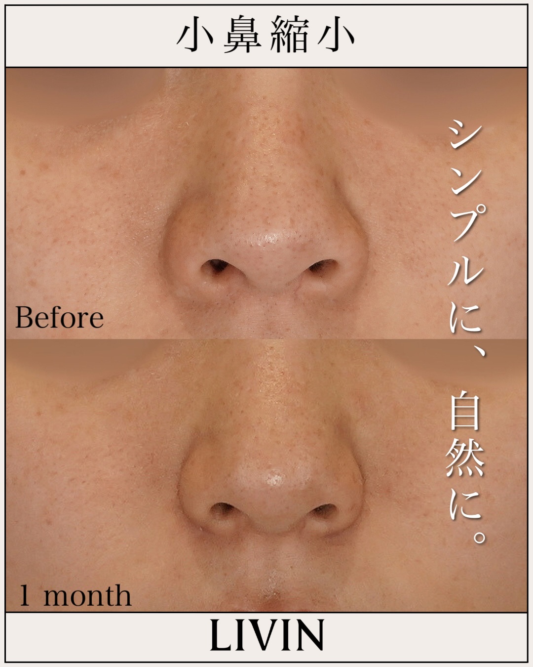 鼻の穴がコンプレックス？形成外科の知識×美容外科のセンスで導く失敗しない鼻整形【LIVIN CLINIC監修】