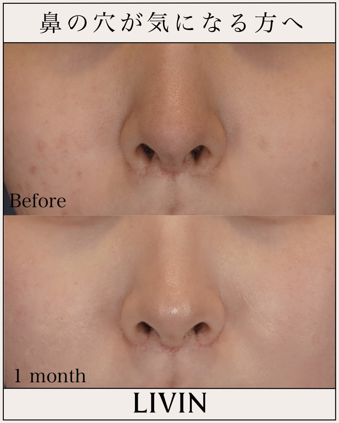 鼻の穴がコンプレックス？形成外科の知識×美容外科のセンスで導く失敗しない鼻整形【LIVIN CLINIC監修】