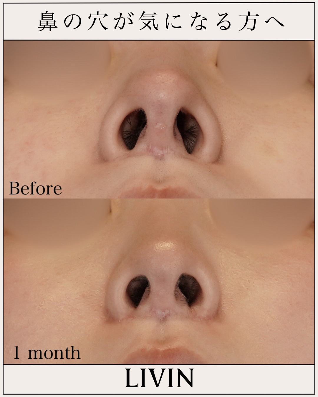 鼻の穴がコンプレックス？形成外科の知識×美容外科のセンスで導く失敗しない鼻整形【LIVIN CLINIC監修】