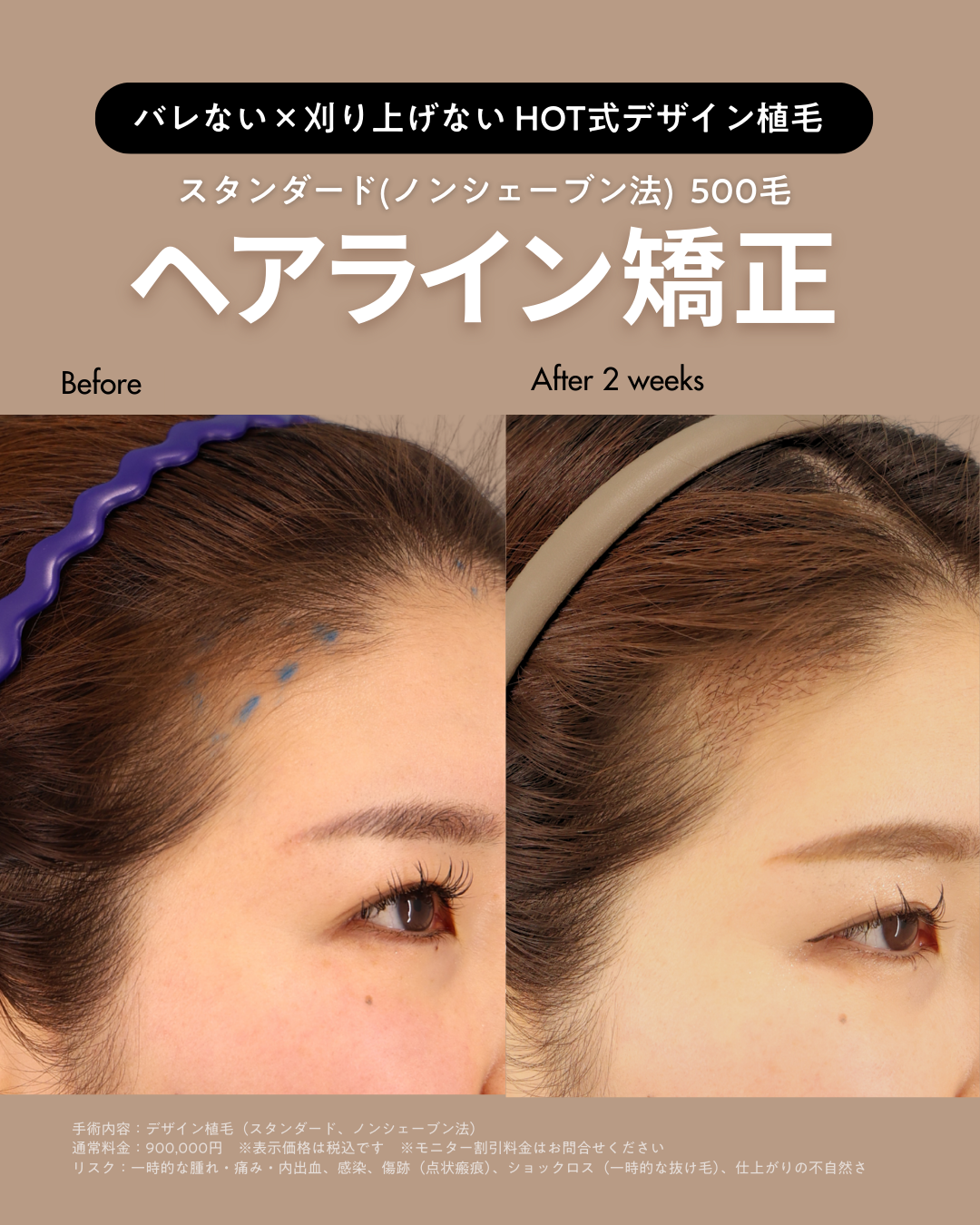 生え際後退の原因は薄毛だけじゃない？薄毛治療専門クリニック【ヘアオブ東京】に聞く“自然で美しいデザイン植毛”とは