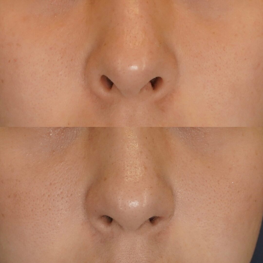 鼻の穴がコンプレックス？形成外科の知識×美容外科のセンスで導く失敗しない鼻整形【LIVIN CLINIC監修】