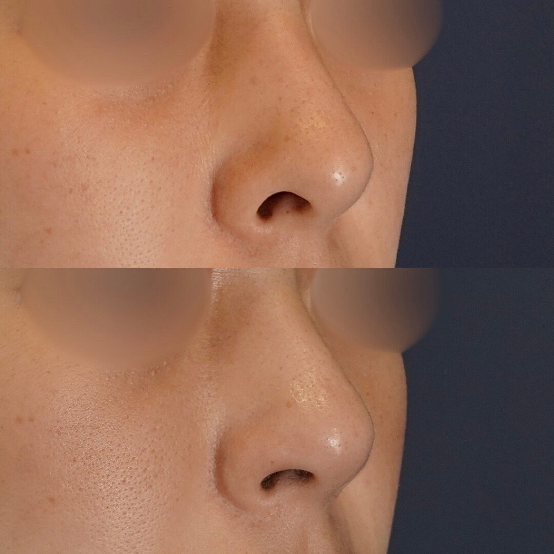 鼻の穴がコンプレックス？形成外科の知識×美容外科のセンスで導く失敗しない鼻整形【LIVIN CLINIC監修】