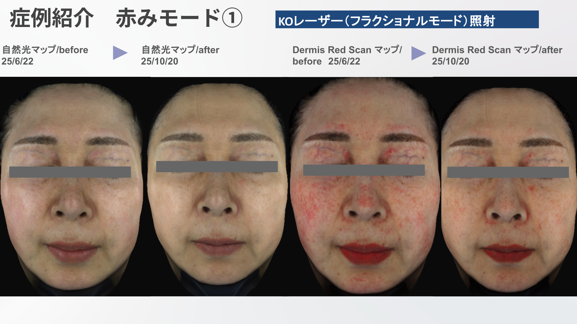 シンクレアアカデミーが日本の美容医療を変える！世界基準の肌診断を学べるウェビナーを独自取材