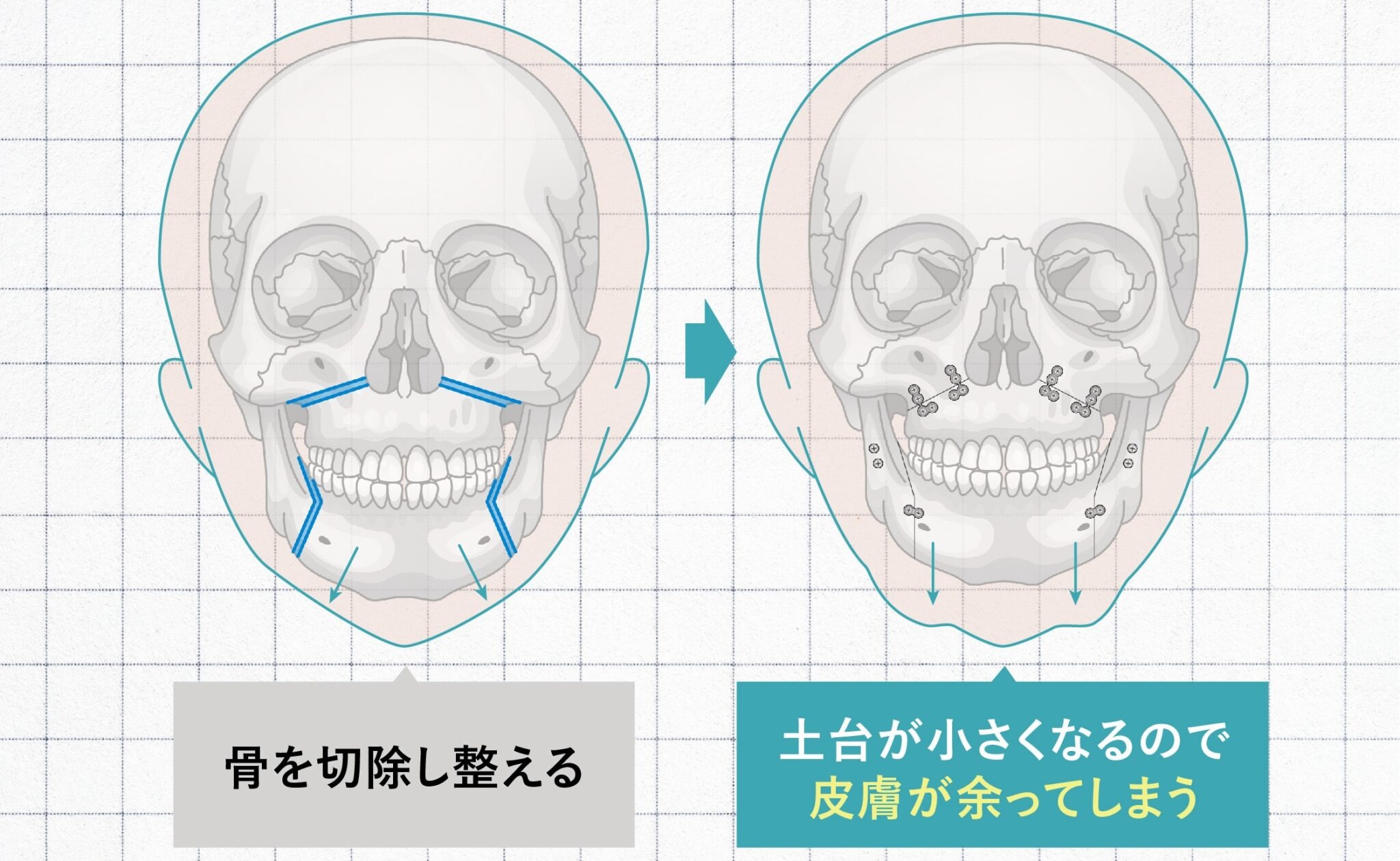 ソフウェーブを東京で受けるなら|コントアクリニック東京が提案する“たるみ×シワ×肌質”の全方位ケア
