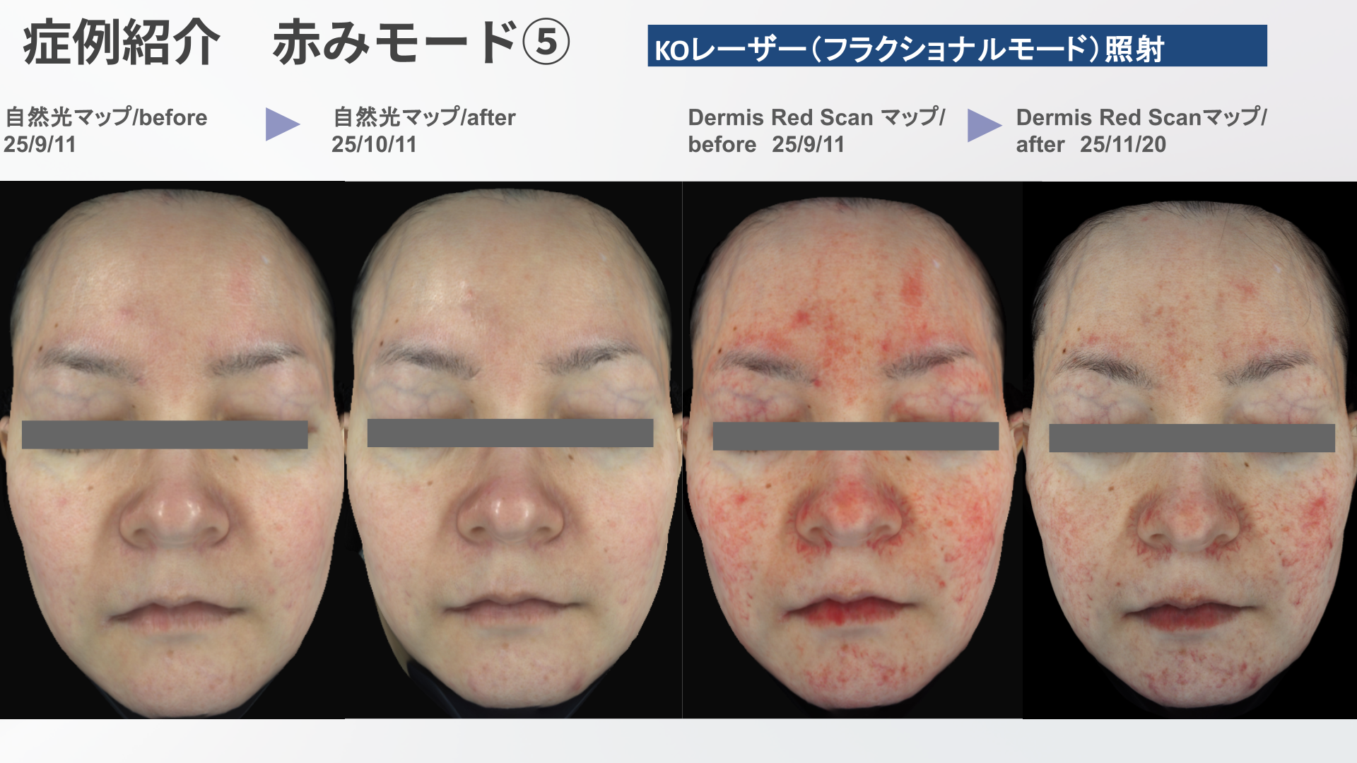 シンクレアアカデミーが日本の美容医療を変える！世界基準の肌診断を学べるウェビナーを独自取材