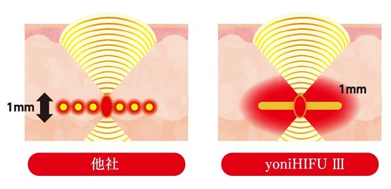性交痛のヒリヒリへの先進施術を徹底比較―モナリザタッチ・フェムフロー・モナフローⓇ・ヨニRF……何がどう違う?【名古屋・咲江レディスクリニック 丹羽院長監修】