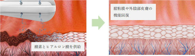 性交痛のヒリヒリへの先進施術を徹底比較―モナリザタッチ・フェムフロー・モナフローⓇ・ヨニRF……何がどう違う?【名古屋・咲江レディスクリニック 丹羽院長監修】