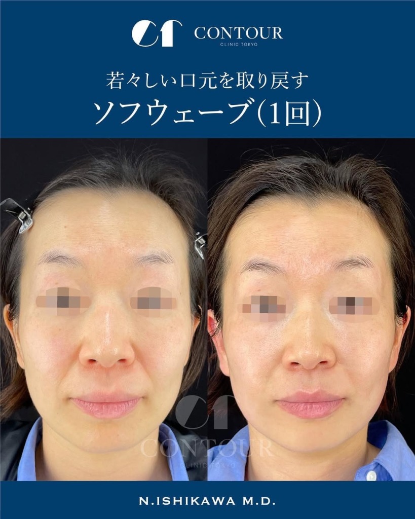 ソフウェーブを東京で受けるなら|コントアクリニック東京が提案する“たるみ×シワ×肌質”の全方位ケア