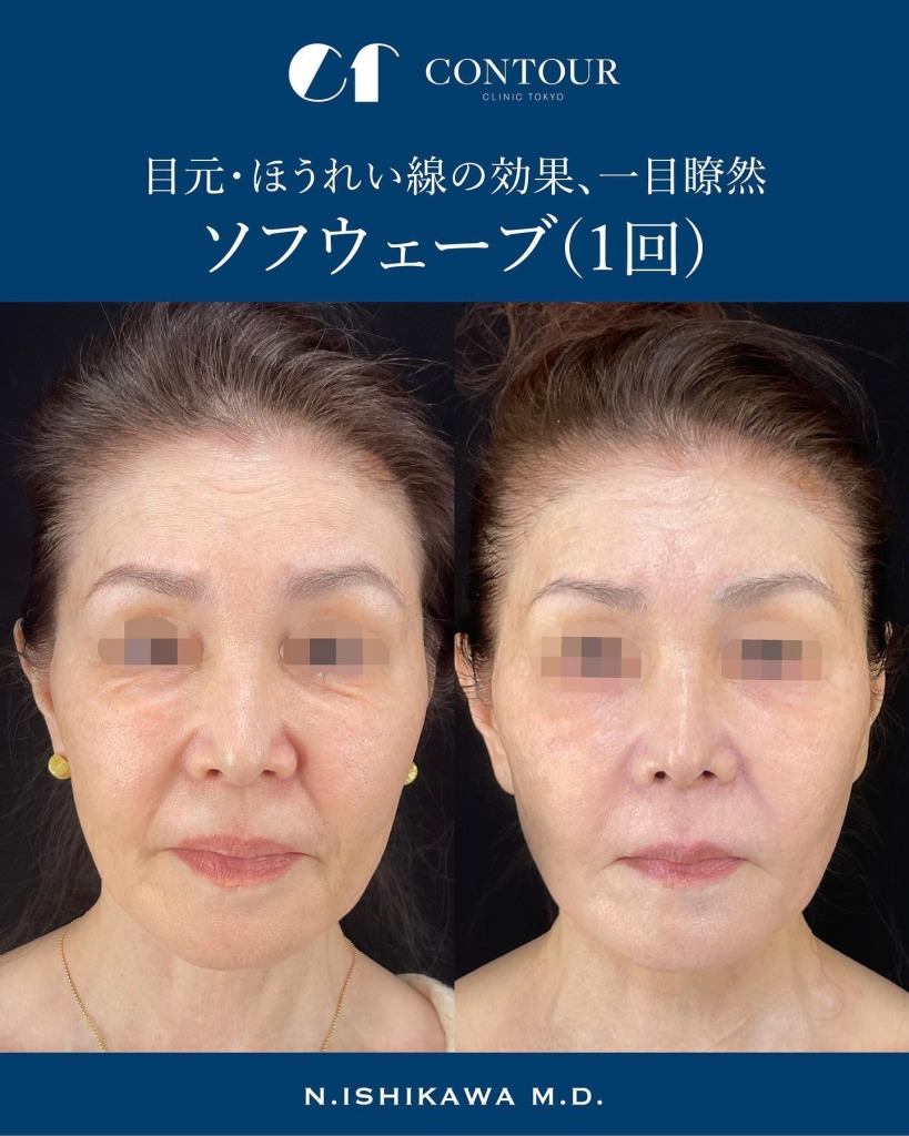 ソフウェーブを東京で受けるなら|コントアクリニック東京が提案する“たるみ×シワ×肌質”の全方位ケア