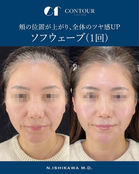 ソフウェーブを東京で受けるなら|コントアクリニック東京が提案する“たるみ×シワ×肌質”の全方位ケア